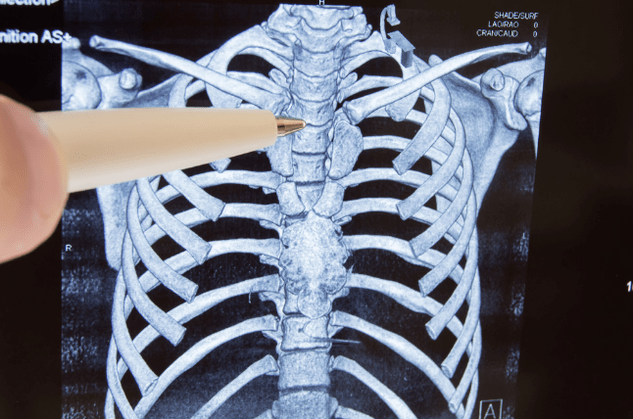 Osteokondroz